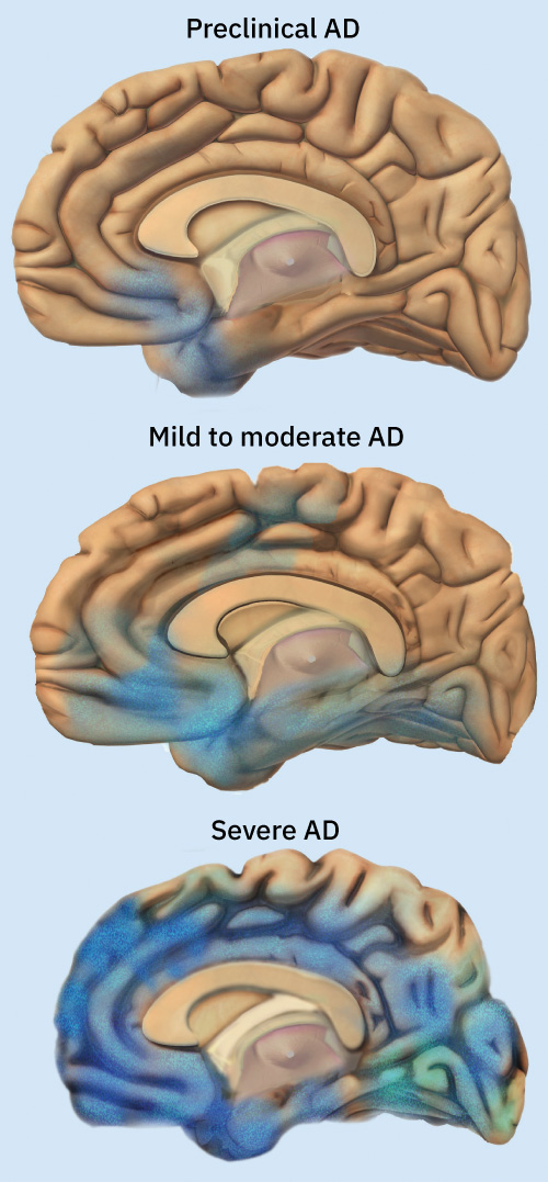 Figure 14.3 In preclinical Alzheimer disease (before symptoms appear), only a small portion of the brain is affected. As the disease progresses through the brain, symptoms become more severe. (credit: “Alzheimer’s Disease, Spreads through the Brain” by National Institute on Aging, National Institutes of Health/flicker, Public Domain)