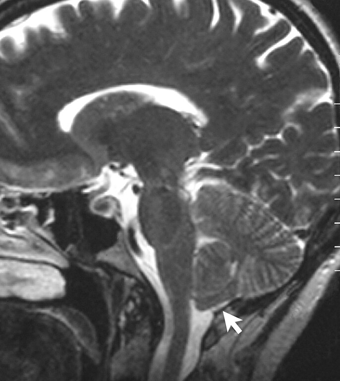 MRI of a patient with a Chiari malformation.