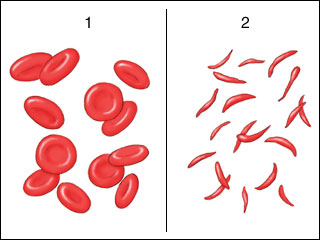 Graphic showing a normal red blood cell compared to a sickle cell.