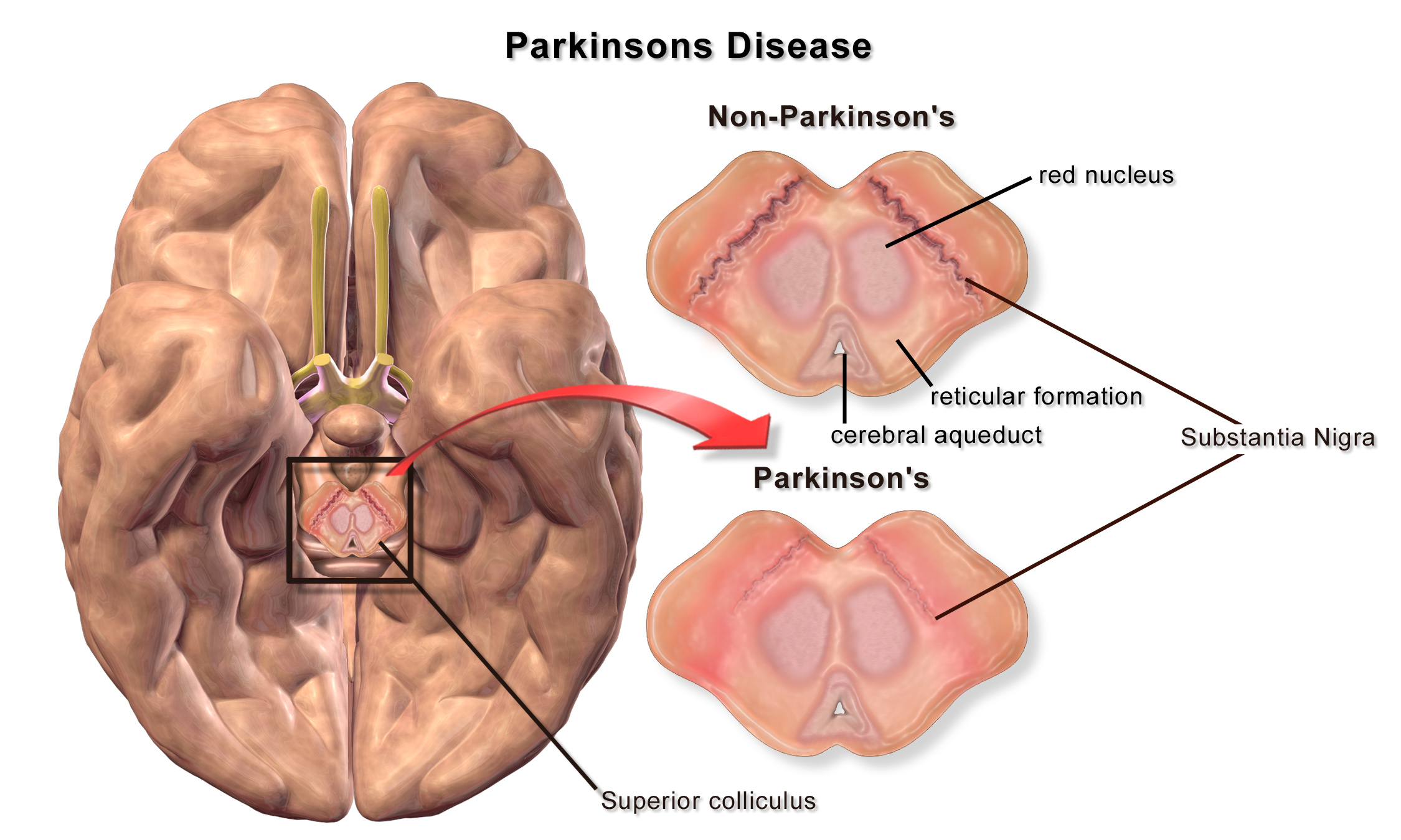 Illustration showing the neuropathology of Parkinson disease.