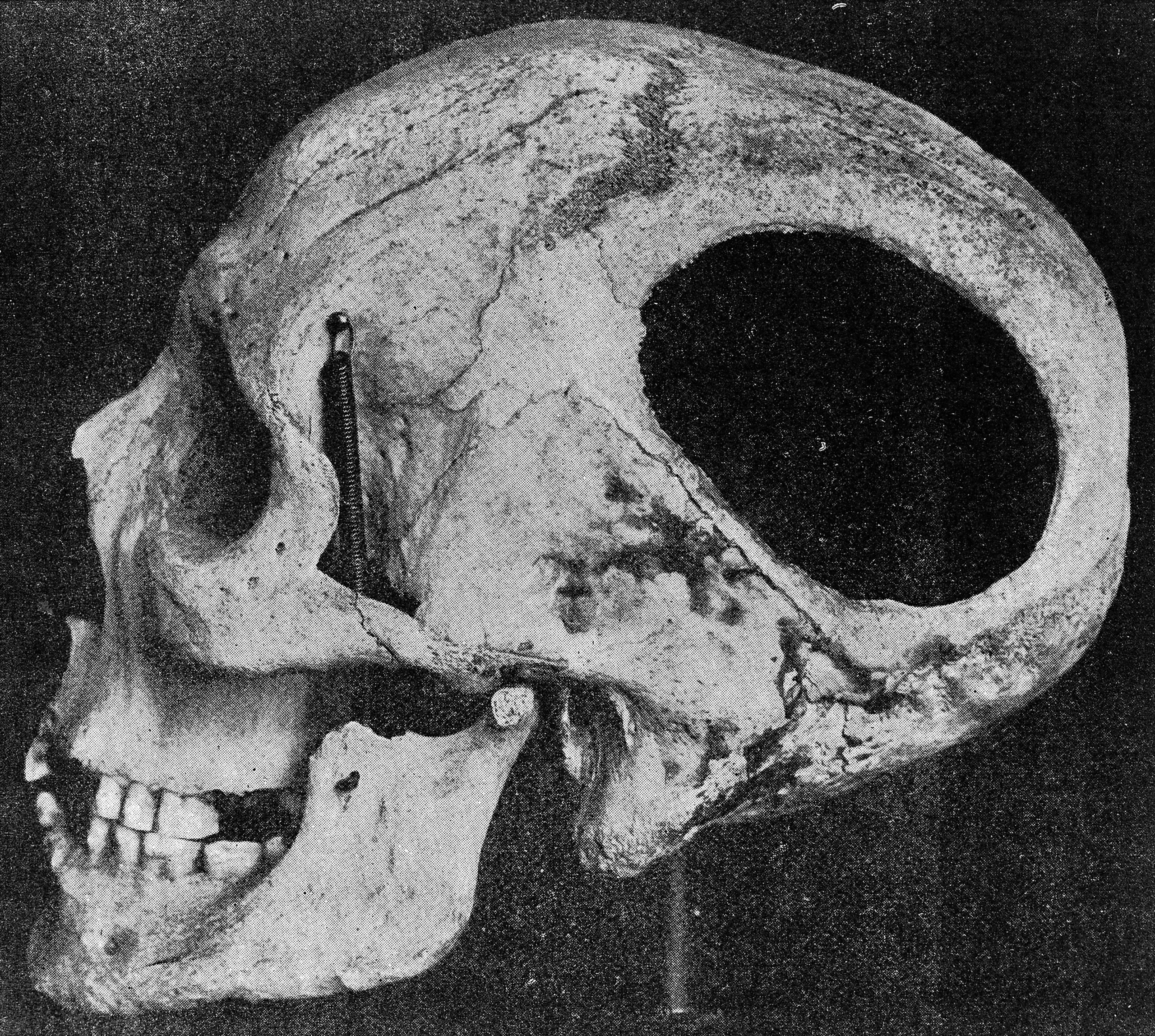 Trepanned skull from an archeological site near Nogent-les-Verges, France.