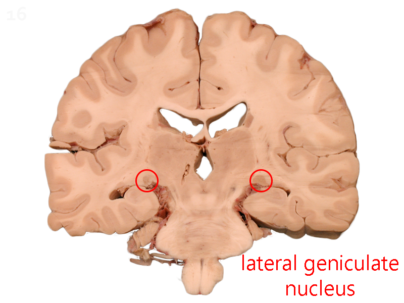 Photograph of a coronal section of the human brain showing the location of the lateral geniculate nucleus.