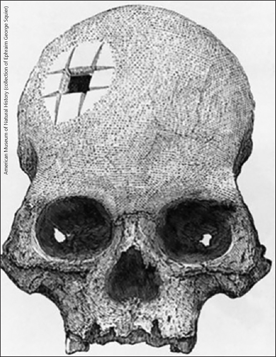 Trepanned skull from an Incan burial site.